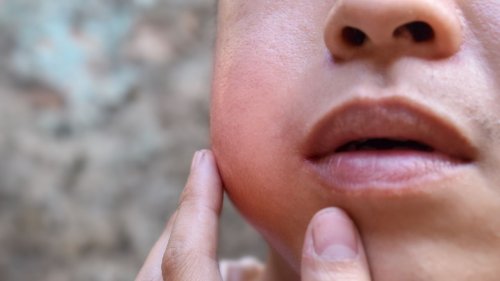 Mumps: Symptome und Behandlung bei Ziegenpeter