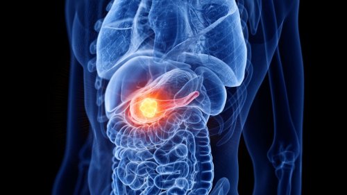 Bauchspeicheldrüsenkrebs: Symptome und Lebenserwartung