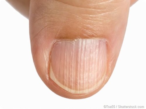 What It Really Means When Ridges Appear On Your Nails