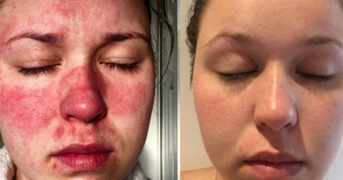 Mum says £20 skin cream cured her face from excruciating pain