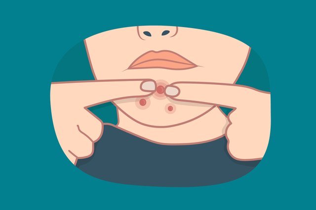 The  Best Natural Remedies for Acne