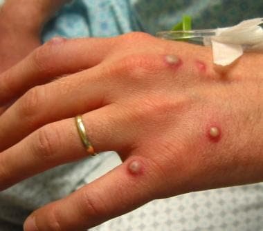 First confirmed case of Monkeypox in Madeira - Madeira Island News Blog