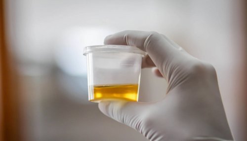 Gewusst? DAS verrät die Urin-Farbe über deine Gesundheit