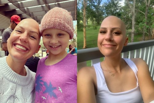 'After 5 years, I've accepted my alopecia. But the grieving process never stops.'
