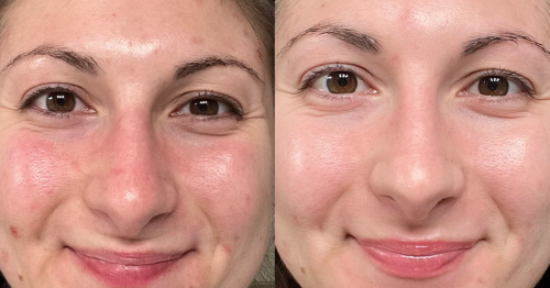 Acne-sufferers ‘obsessed’ with ‘game changer’ toner that transforms skin and smells ‘amazing’