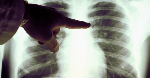 Face, neck and fingers - why changes here could mean you have lung cancer