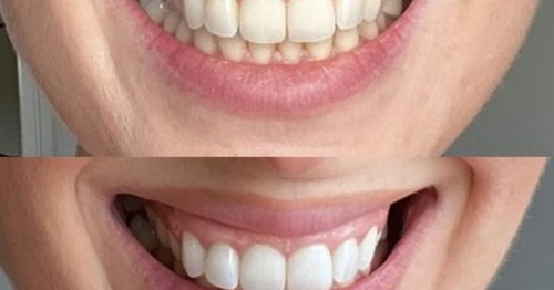 Amazon's best-selling teeth whitener hits 'lowest' price since Prime Day in Easter sale