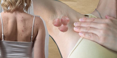 Qu’est-ce que la maladie de Verneuil, cette pathologie chronique qui affecte la peau ?