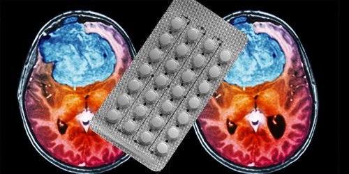 Certains contraceptifs pourraient favoriser le développement de tumeurs cérébrales, selon une étude française
