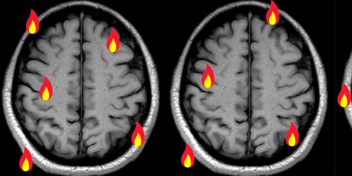 Ces quatre facteurs méconnus (mais courants) causeraient des inflammations du cerveau