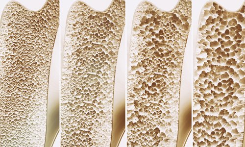 Osteoporosis and Massage: Etiology, Signs & Safety