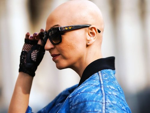 Alopecia areata: Arthritis drug helps 1 in 3 people regrow hair