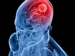 Scientists discover enzyme that supports brain tumor growth