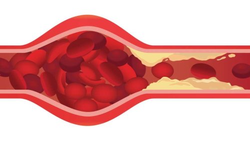 Could it be possible to eliminate clogged arteries?
