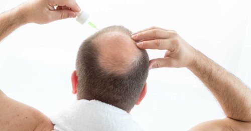 Scientists Announce Big Breakthrough in Race to Cure Men's Baldness