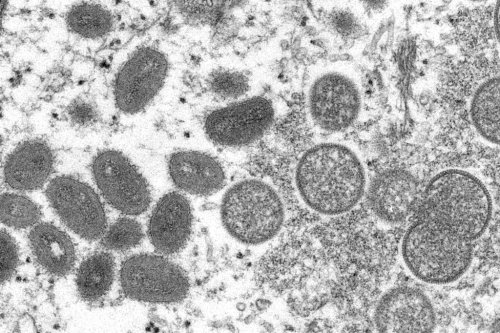 Monkeypox is ‘not going to spread like wildfire’ after Massachusetts case, smallpox vaccine can protect people