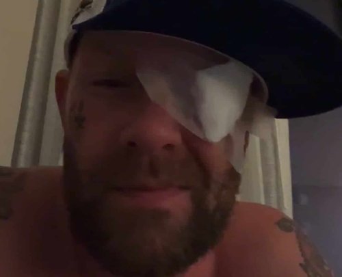 Le chanteur de Five Finger Death Punch, Ivan Moody, s'est blessé à l'œil lors d'un incident impliquant un rayon laser