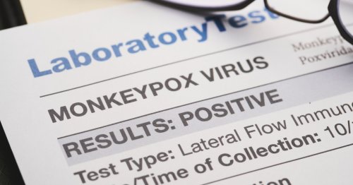 How do you catch monkeypox and is it deadly?