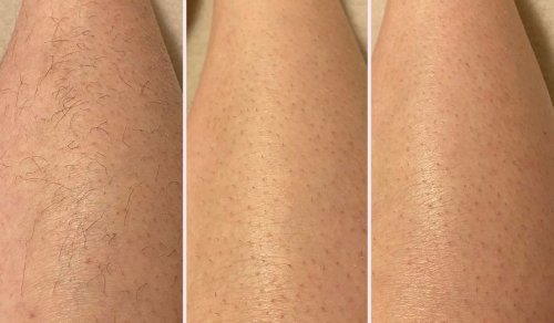 You might never have to shave your legs again with this incredible device and real results after just a few weeks