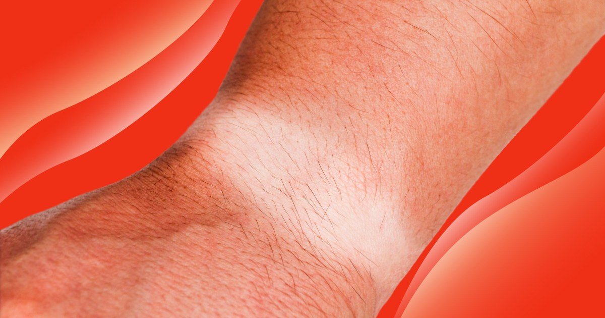 The ‘rotting’ summer wrist condition that keeps being mistaken for tan lines