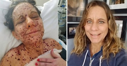 Woman with 6,000 tumours all over her body makes remarkable recovery