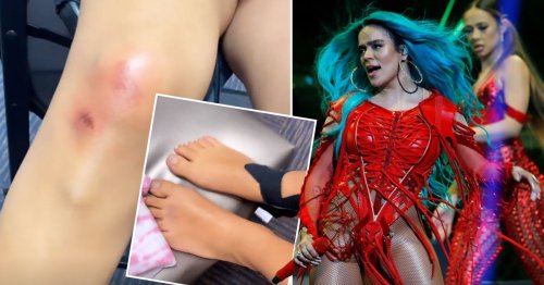 Karol G reveals nasty bruises and bloody cuts after massive stage fall: ‘I think my knee broke’