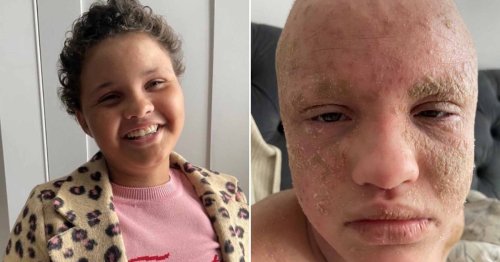 Schoolgirl loses sight in one eye after using anti-inflammatory creams for eczema