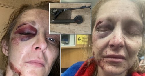 Woman nearly lost her eye after she crashed her £180 e-scooter