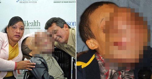 Boy dies after having surgery to remove 10lb tumour from his face