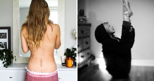 Woman heard her spine go pop and broke her back while doing yoga