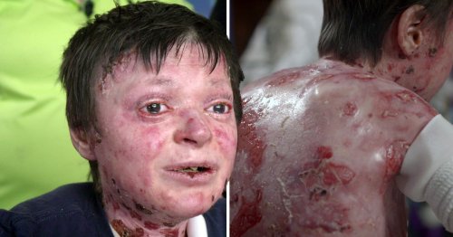 Boy with no skin but is too afraid to have life-changing treatment