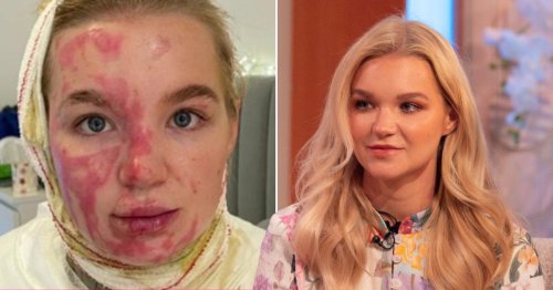 AJ Pritchard’s girlfriend Abbie Quinnen praises Katie Piper’s support over horrific burns: ‘I’ve really struggled’
