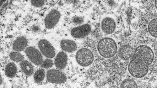 First US monkeypox case reported this year, health officials say. What to know