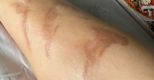 Woman returns home from holiday in Bali with mystery burn marks that could last 'years'