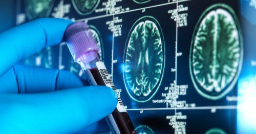Cold sore virus leaves people at far higher risk of Alzheimer’s, study suggests