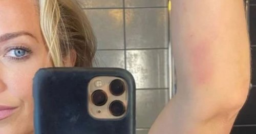 A Place in the Sun star shows bleeding gums and bruising from ITP disorder