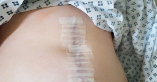 Girl, 13, left needing surgery on appendix and bowel after copying TikTok craze