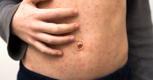 Measles outbreak: Cases continue to spike as government issues urgent school and nursery warning