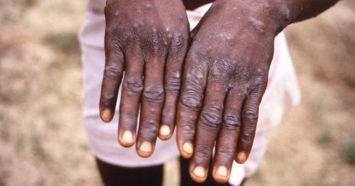 Monkeypox remains infectious long after scabs have healed, worrying study suggests