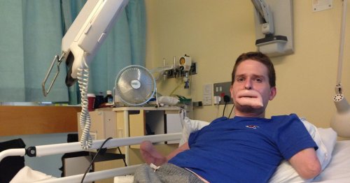 Brit thought he had 'man flu' but lost all his limbs and parts of his face to Strep A