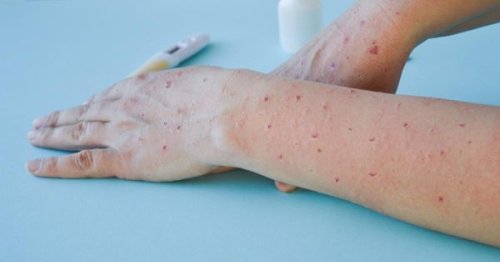 Monkeypox Cases In Quebec Have Jumped To 211 In Just One Month