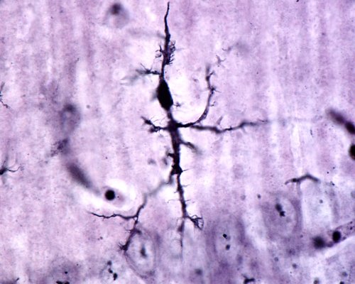 What Goes Wrong in MS? Clues May Lie In Brain's Viral Defense System