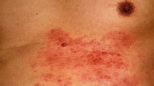 Ist Gürtelrose durch mRNA-Impfung möglich?