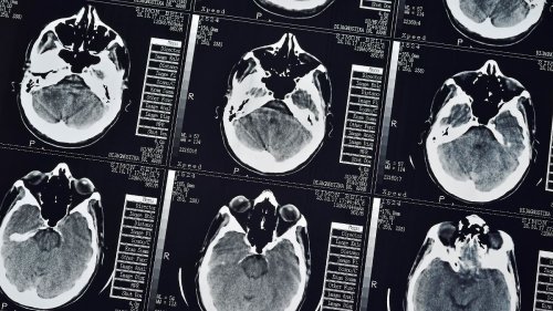 Post-Covid-Symptome sind im Gehirn sichtbar