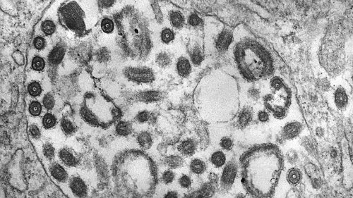 Tödliches Marburg-Virus bricht in Tansania aus
