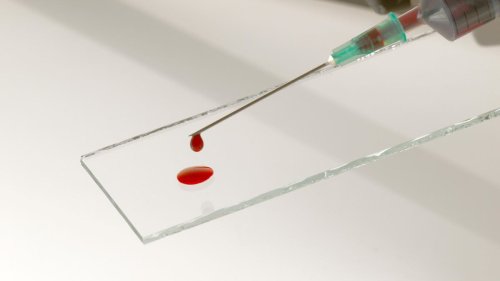 Erster Bluttest für Alzheimer in den USA zugelassen