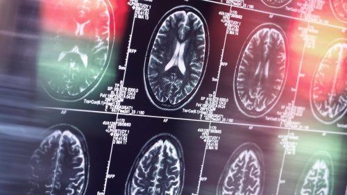 Covid-19 erhöht laut Studie Alzheimer-Risiko