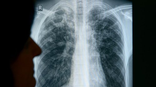 WHO: Zusammenbruch der Tuberkulose-Programme droht