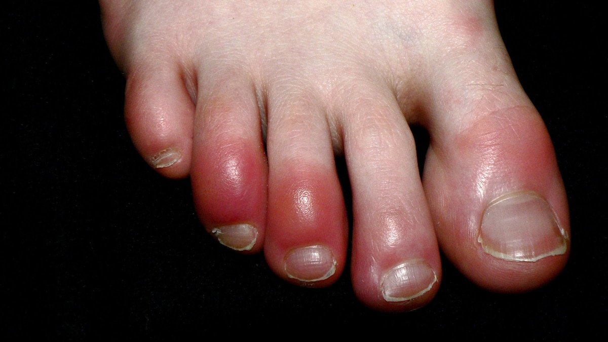 Mysterious wave of COVID toes still has scientists stumped