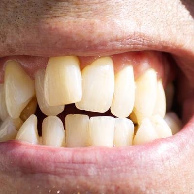 Pourquoi nos ancêtres avaient-ils des dents plus alignées que nous ?